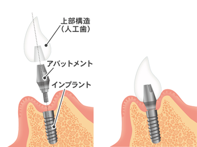 インプラント治療について